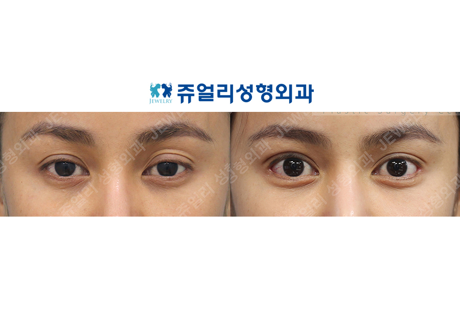 Double Eyelids Revision (Ptosis Correction), Lateral Canthoplasty, Lower Lateral Canthoplasty, Under Eye Fat Repositioning (Dark Circle Eye Bag Removal, Loveband)