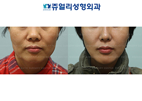 Mini Lifting (Jaw Line Lifting)