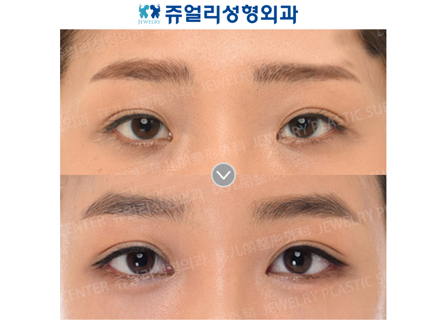 Double Eyelids Incision