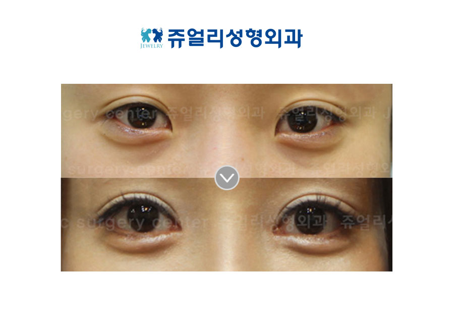 Upper/Lower Blepharoplasty