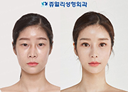 Double Eyelids (Lower Lateral Canthoplasty, Lateral Canthoplasty), Lower Blepharoplasty (Dark Circle Removal, Loveband), Bent Nose (Reoperation), Nostrils Reduction, Fat Grafting, Cheek/Chin Liposuction