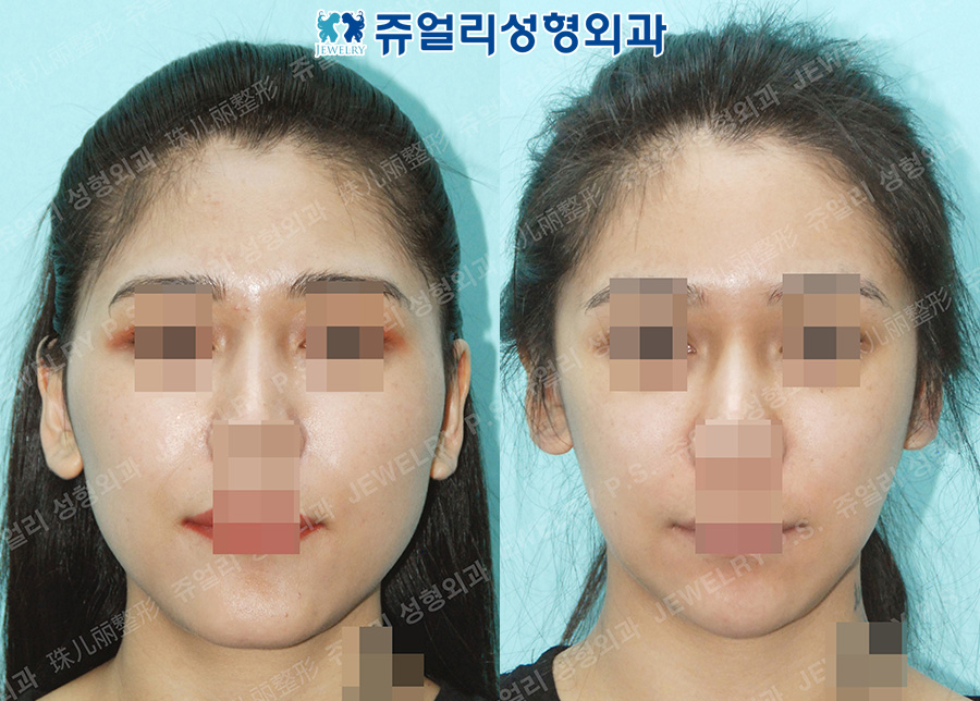 Cheekbone Reduction, Square Jaw Reduction, T-osteotomy, Fat Grafting