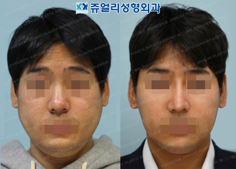 Nose Surgery, Cheek&Chin Liposuction, Chin Botox