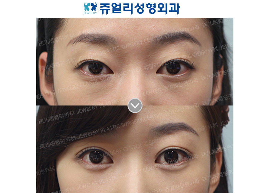 Double Eyelids+Dark Circle (Fat-Repositioning Transconjunctival)