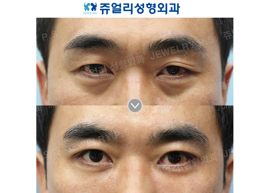 Double Eyelid (Non-Incision, Ptosis Correction), Dark Circle Removal