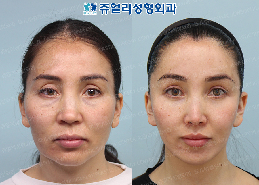 Double Chin Liposuction, Face Lifting, Cheekbone Reduction