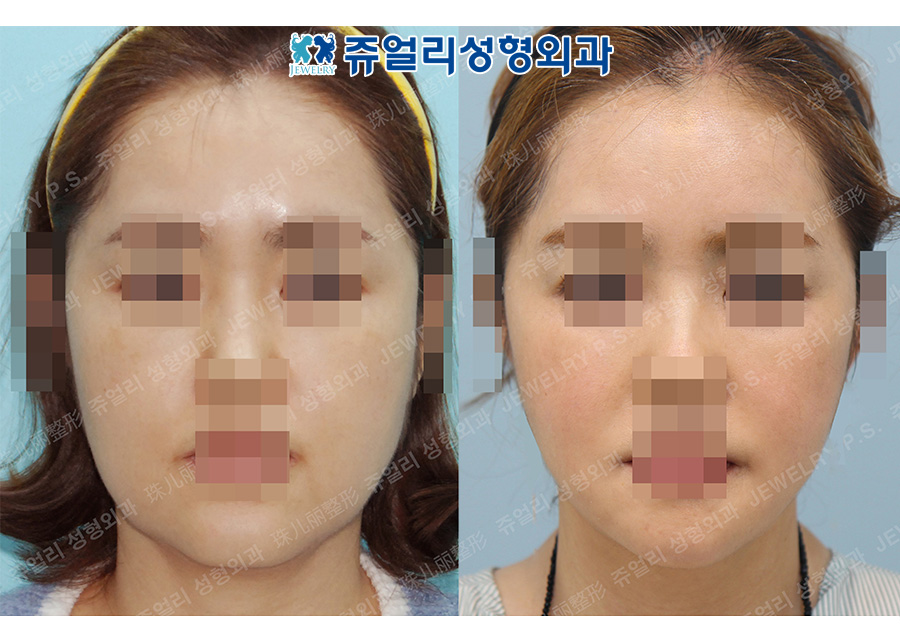 Mini Lifting, Cheek+Jaw Liposuction, Square Jaw Reduction, T-osteotomy (Front Chin Reduction and Advancement)