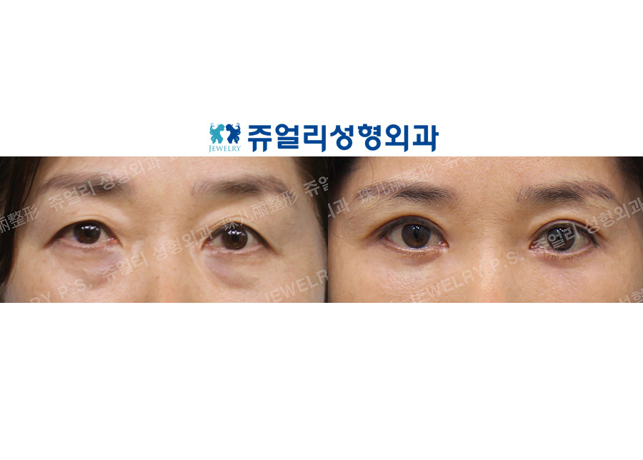 Upper Blepharoplasty, Lower Blepharoplasty