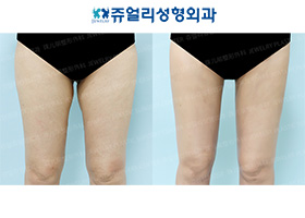 Thigh Liposuction