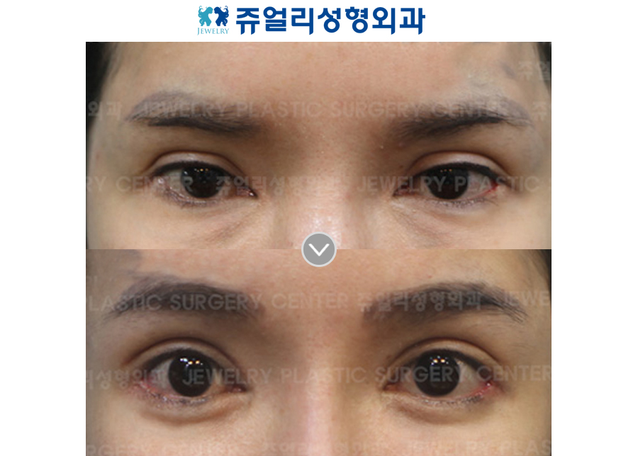 Ptosis Correction + Ptosis