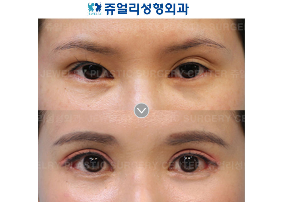 Ptosis (Eyes Enlargement)+Lateral Canthoplasty+Lower Lateral Canthoplasty+Dark Circle Removal (Fat-Repositioning)