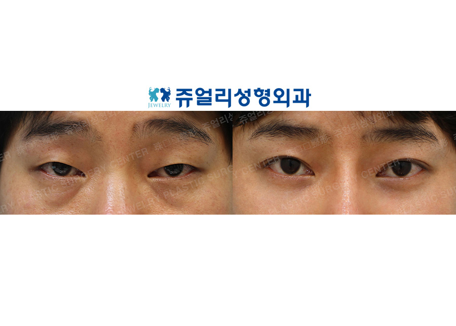 Non-Incisional Ptosis Correction, Dark Circle Removal