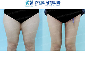 Thigh Liposuction