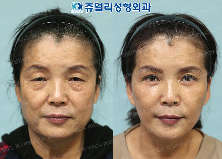 Upper Blepharoplasty, Lower Blepharoplasty, Fat Grafting, Face-Neck Lifting