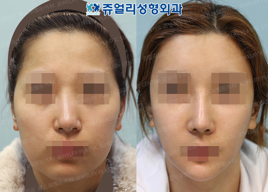 Nose Surgery