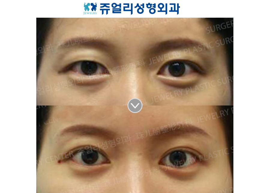 Double Eyelids Incision