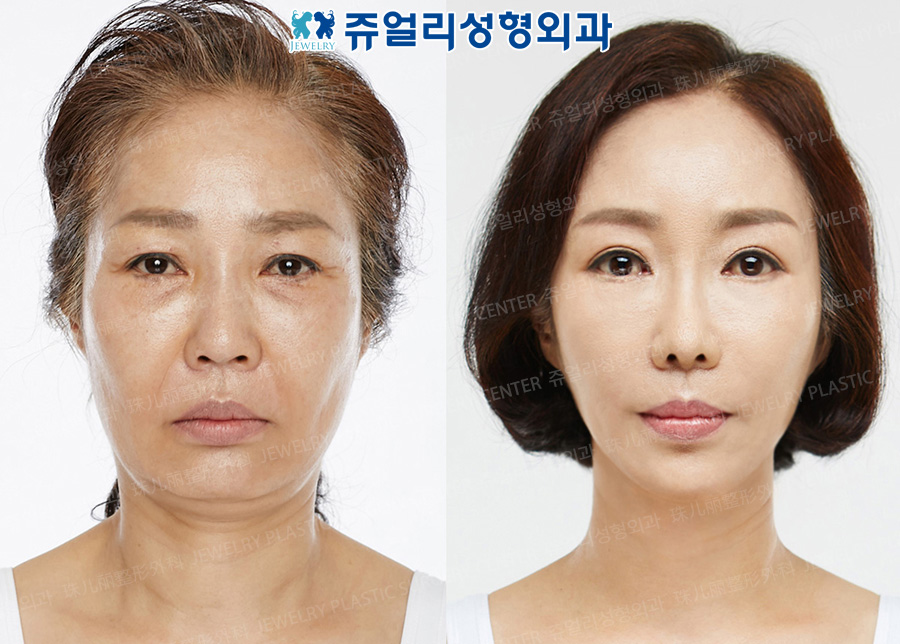 Lower Blepharoplasty, Brow Lifting, Face Lifting, Fat Grafting, Nose Reoperation,  Paranasal Reoperation, Glabella Botox