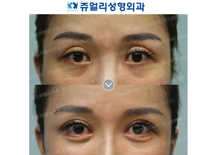 Double Eyelids Reoperation