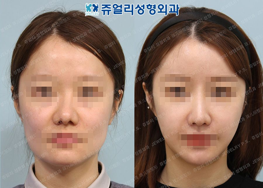 Rhinoplasty, Fat Grafting, Facial Contouring (Mandible Jaw Reduction, T-Osteotomy)