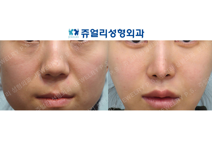 Philtrum Reduction, Lip Filler