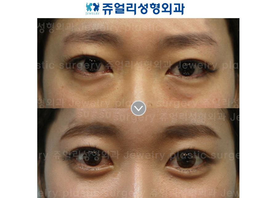Fat-Repositioning Transconjunctival + Loveband