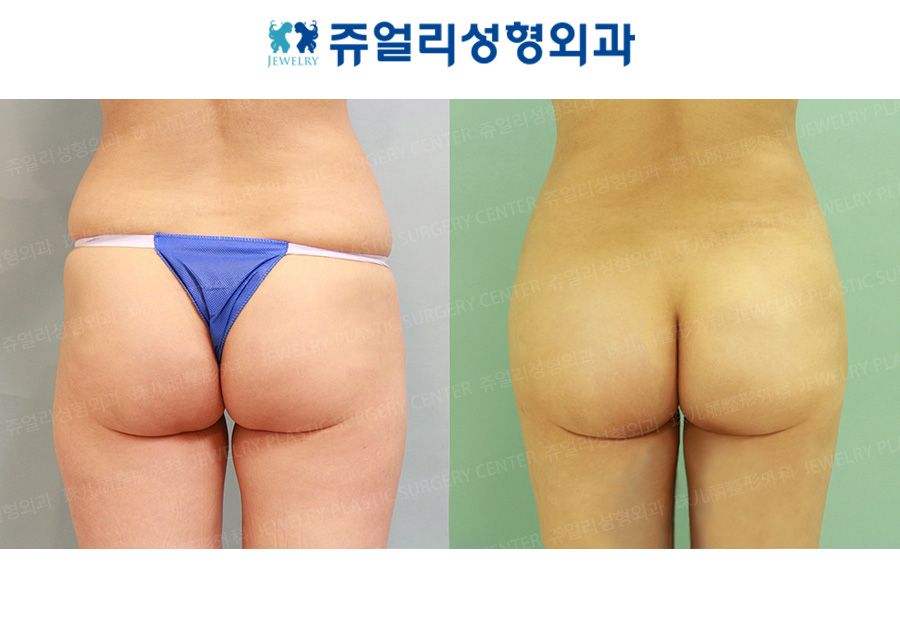 Hip-up (Fat Grafting)