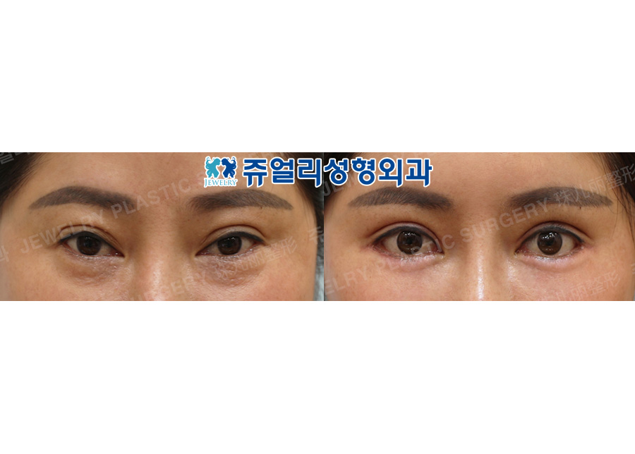 Double Eyelids Reoperation (Ptosis), Lateral+Lower Lateral Canthoplasty, Lower Blepharoplasty