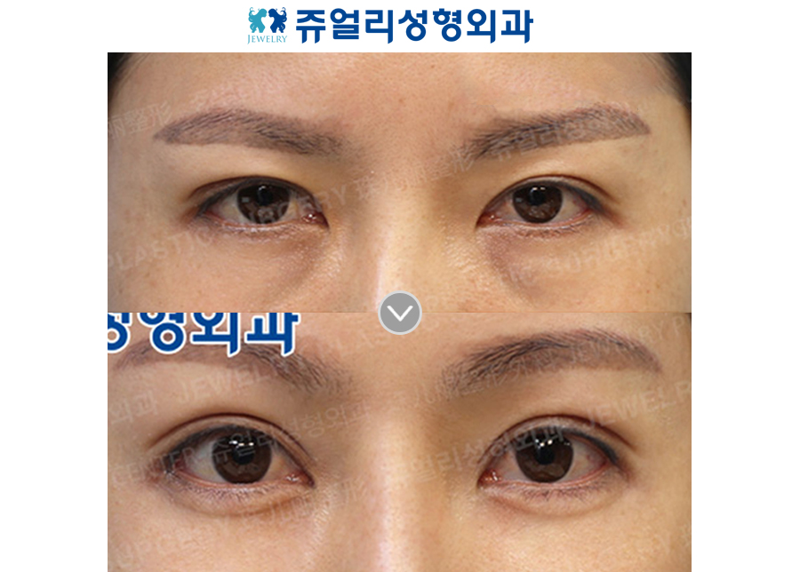 Forehead Lifting, Ptosis, Fat-Repositioning Transconjunctival, Nose Reoperation (Autogenous Rib Cartilage), Fat Grafting, Cheek + Jaw Liposuction, Jaw Muscle Lifting
