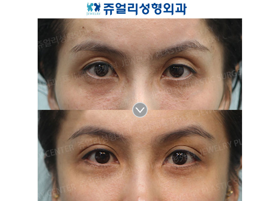 Eyelids Fat Grafting  + Double Eyelids (Non-Incision)