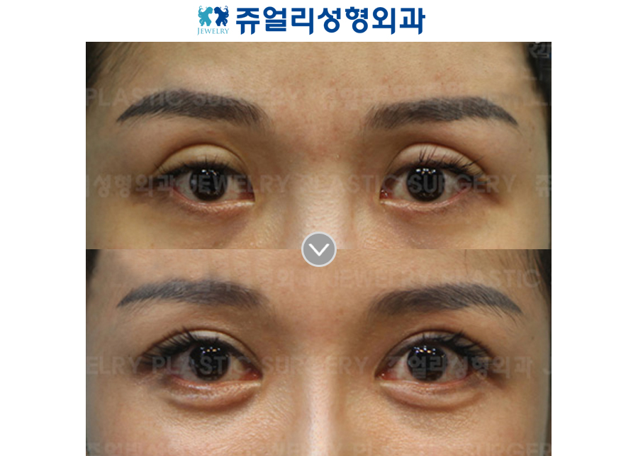 Ptosis Correction + Ptosis
