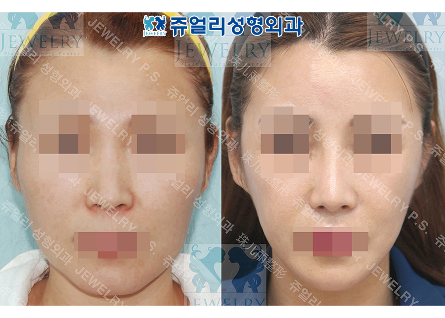 Rhinoplasty 2. Zygoma, square jaw, T-osteotomy