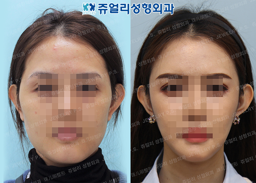 Cheekbone Reduction, Square Jaw Reduction, T-osteotomy