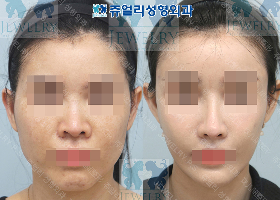 Revision rhinoplasty (alar reduction, nostril lowering) 2. Zygoma, square jaw, T-osteotomy 3. Fat grafting