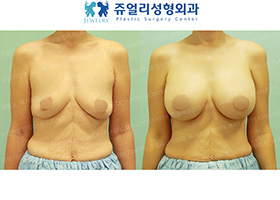 Breast Augmentation