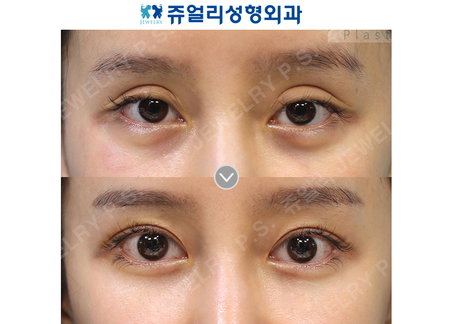Double Eyelids Reoperation (Line Reduction) + Dark Circles (Loveband Removal & Fat-Repositioning Transconjunctival)