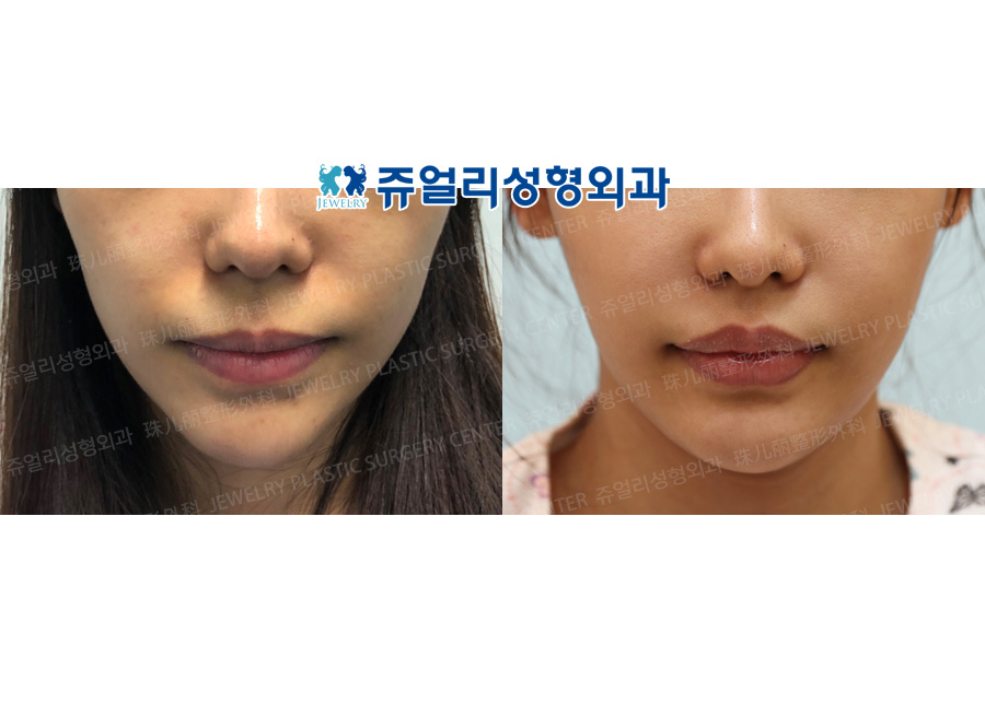 Philtrum Reduction