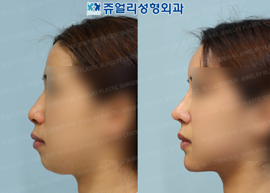 Double Chin Liposuction, Chin Implant