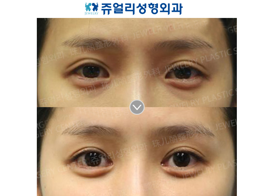 Incision Reoperation + Ptosis