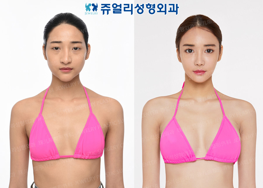 Breast Augmentation (Teardrop), Eyes Surgery (Epicanthoplasty, Lateral Canthoplasty, Lower Lateral Canthoplasty, Fat-Repositioning Transconjunctival, Loveband), Nose Reoperation, Fat Grafting, Cheek & Chin Liposuction, Chin Implant, Chin Botox