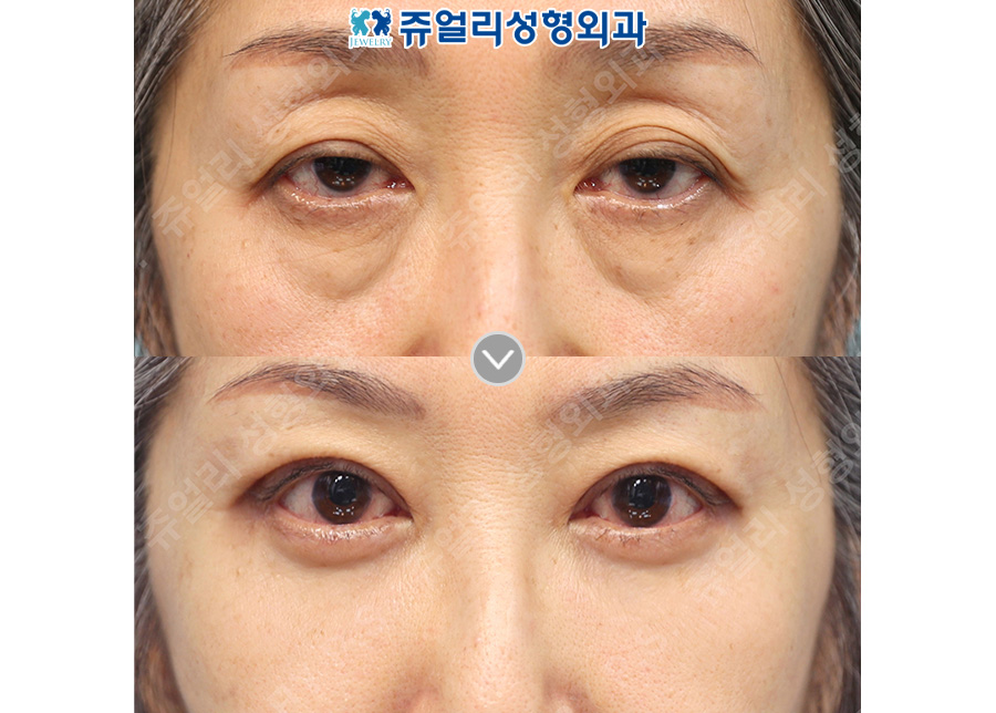 Upper blepharoplasty + lower blepharoplasty + midface lift + fat grafting (upper eyelid)