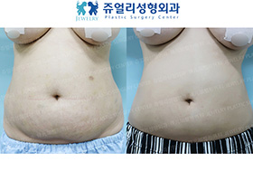 Abdominal Wall Surgery + Liposuction
