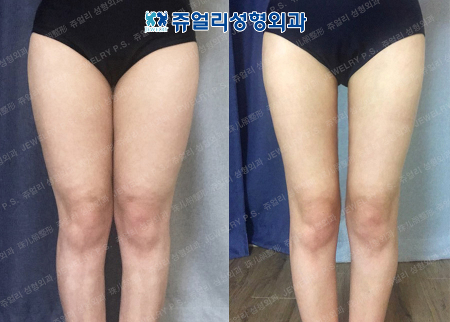 Thighs Liposuction, Hip Up (Fat Grafting)