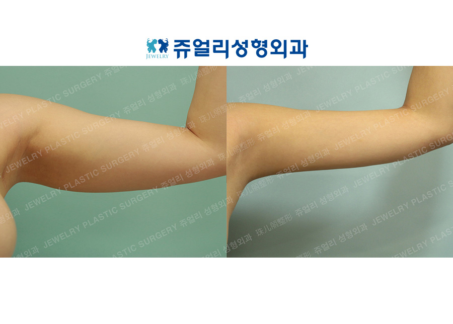 Arm Liposuction