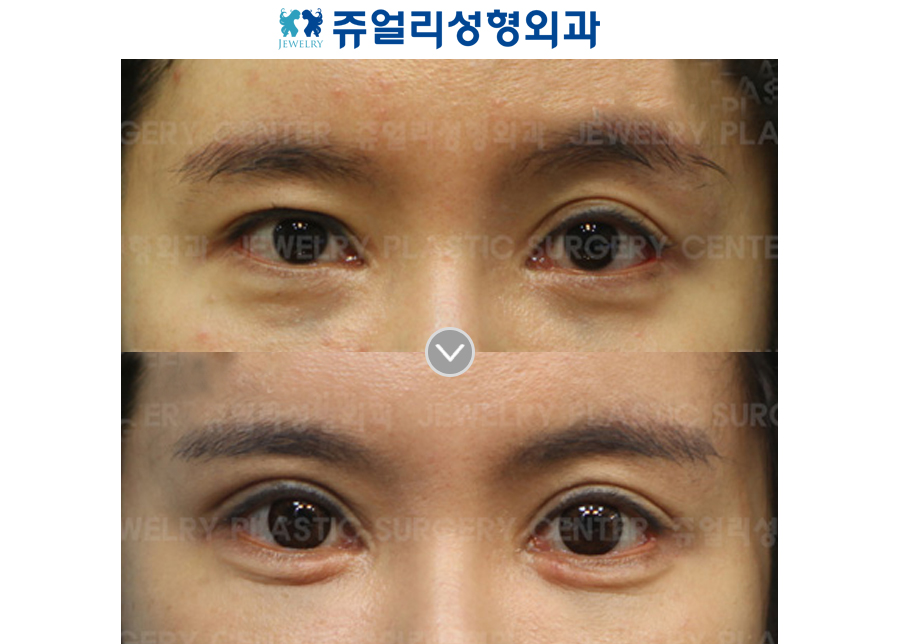 Ptosis Correction + Ptosis