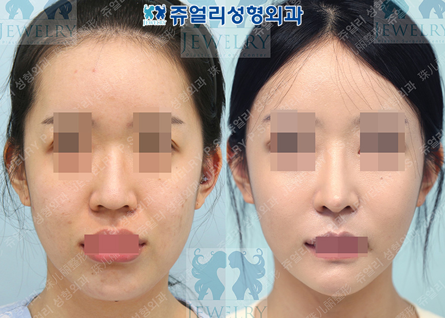 Rhinoplasty (autologous rib cartilage) + fat grafting + facial contouring (square jaw, front chin reduction) + cheek, double chin liposuction