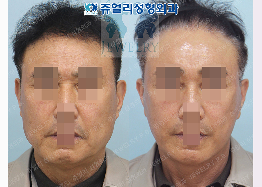 Facial Lifting, Neck Wrinkle Lifting