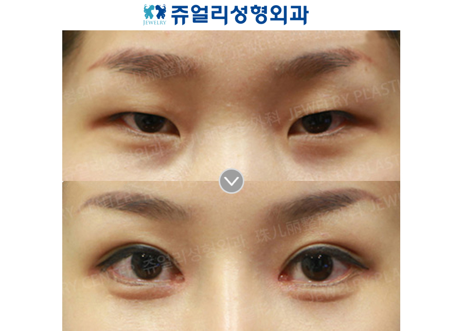 Double Eyelids Non-Incision