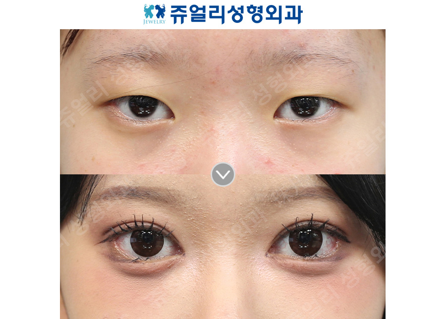 Double eyelid surgery + epicanthoplasty, lateral canthoplasty, lower canthoplasty + under-eye fat repositioning + aegyo-sal