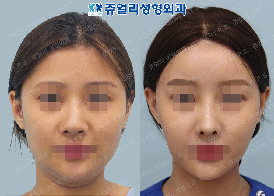 Fat Grafting, Cheek+Double Chin Liposuction