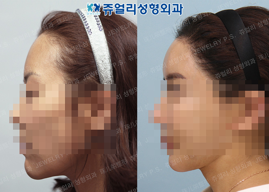 Forehead Implant